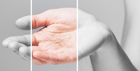 I started with alopecia when I was very young