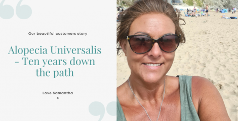 Alopecia Universalis – Ten years down the path