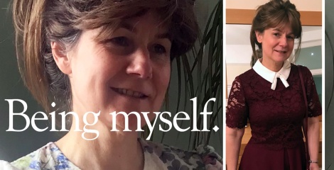 My personal hair loss story