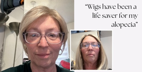 Wigs have been a life saver for my alopecia
