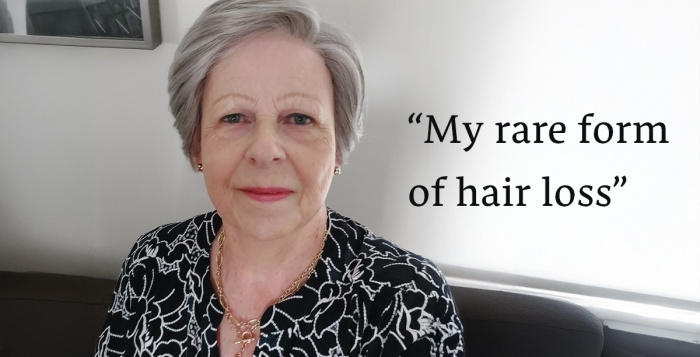 What’s my ‘rare form’ of hair loss?