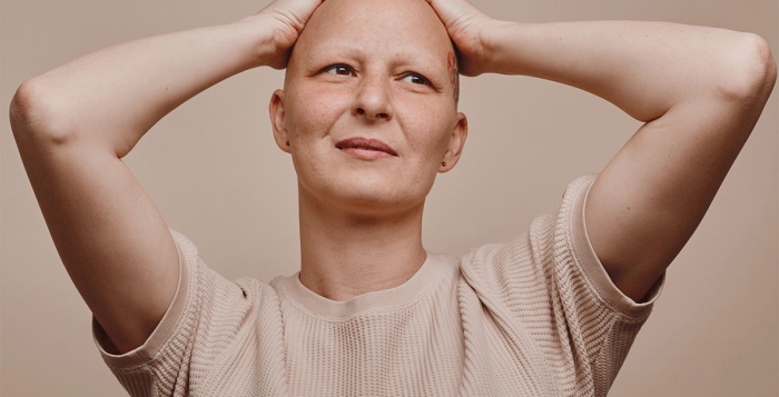 Alopecia Universalis | Living with hair loss across the body