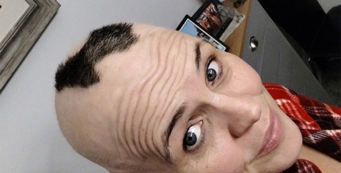 Alopecia Areata | What to do when you notice a bald patch
