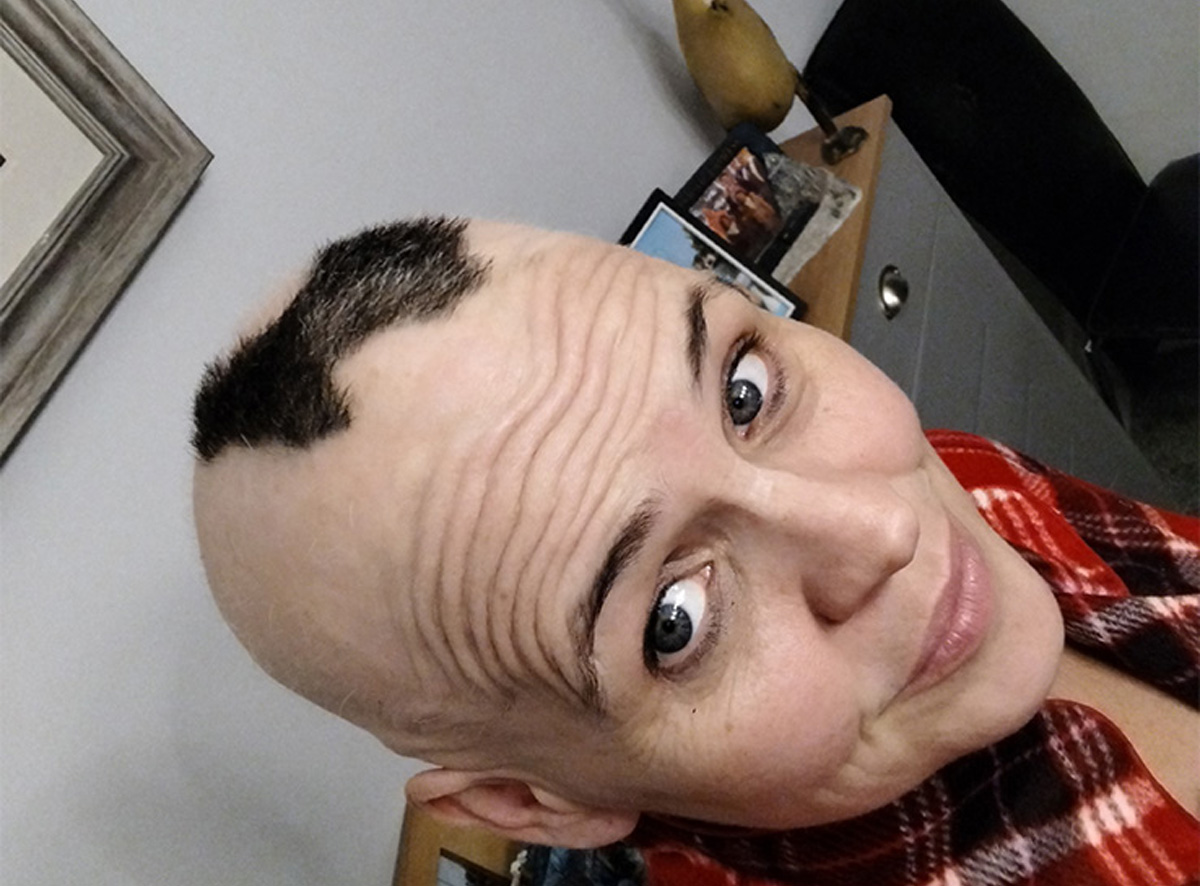 Customer showing an Alopecia Areata patch