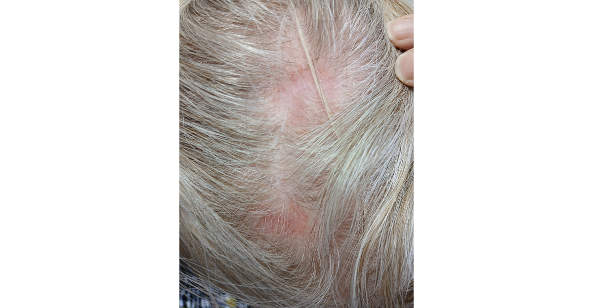 one-small-alopecia-patch-2