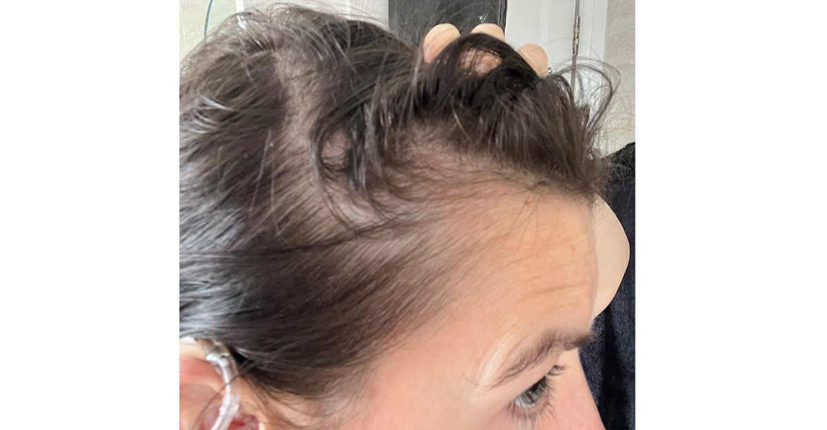 one-small-alopecia-patch-3