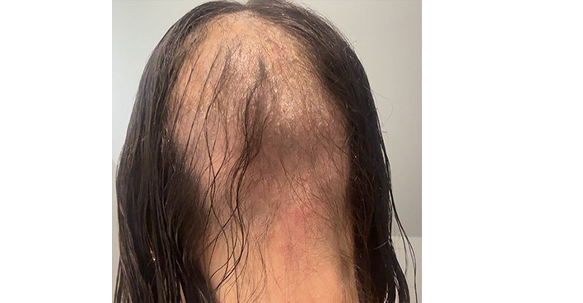 one-small-alopecia-patch-4