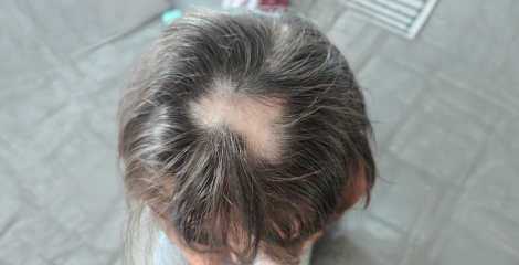 Why One Small Alopecia Patch Can Feel Like So Much More