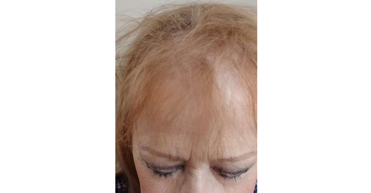 one-small-alopecia-patch-7