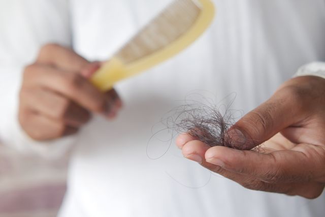 Man examining hair loss in his hairbrush, showing diffuse hair shedding caused by telogen effluvium.