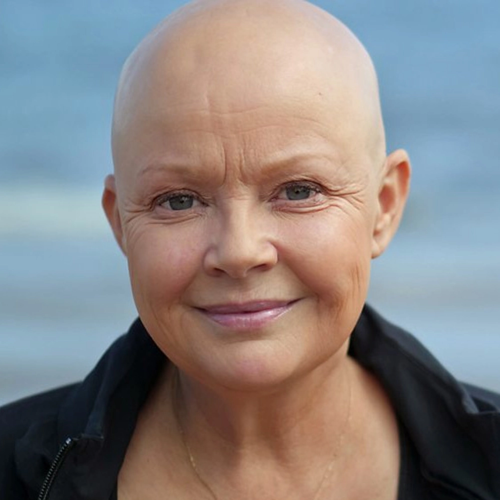 Celebrities Who Transformed Their Hair Loss Experience